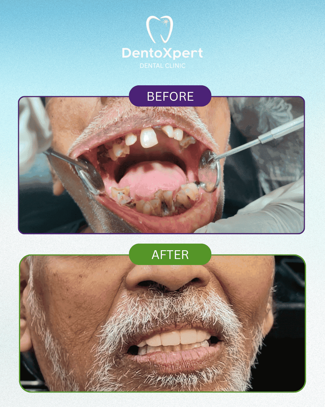 Before and after dental treatment result at DentoXpert Dental Clinic in Thane